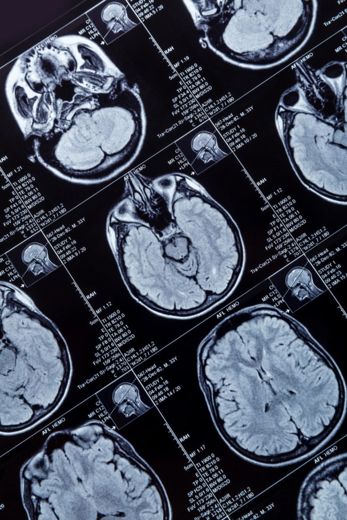 Brain MRI. Magnetic resonance imaging photography of human brain closeup